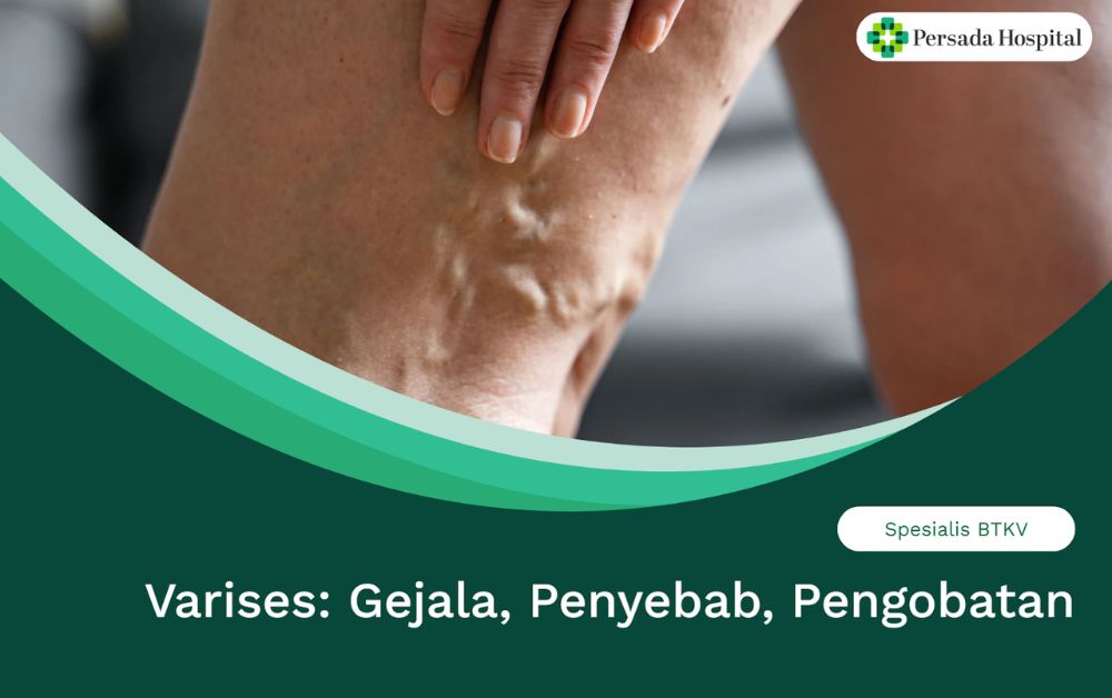 Varises: Gejala, Penyebab, Pengobatan