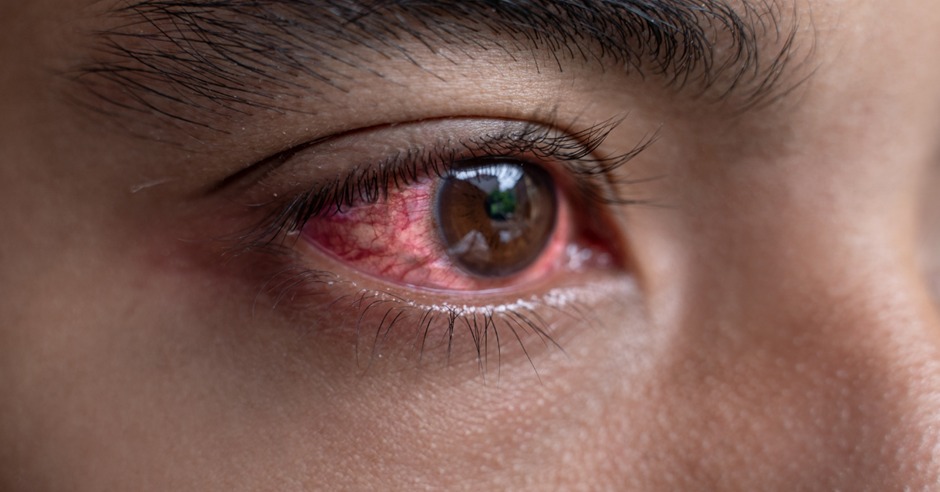 Ragam Jenis Penyakit Mata dan Pengobatannya