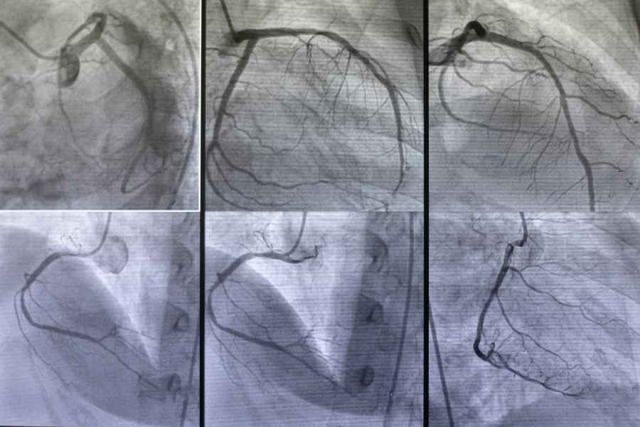 DSA (Digital Subtraction Angiography) - Penjelasan Lengkap