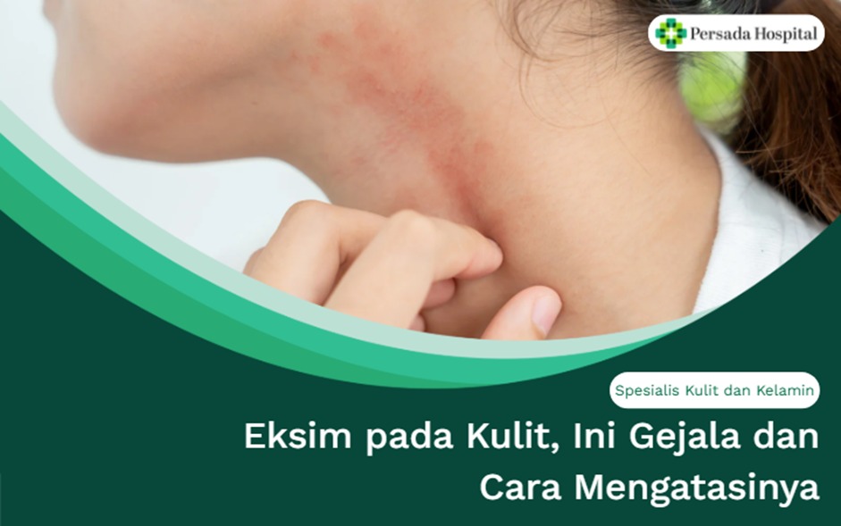 Eksim pada Kulit, Ini Gejala dan Cara Mengatasinya