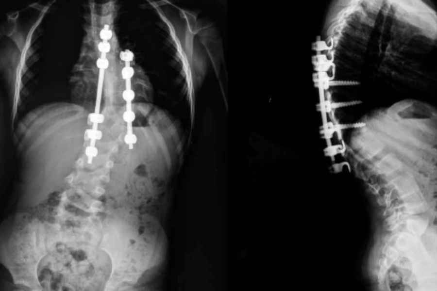 5 Cara Mencegah Skoliosis dan Ragam Penyebabnya