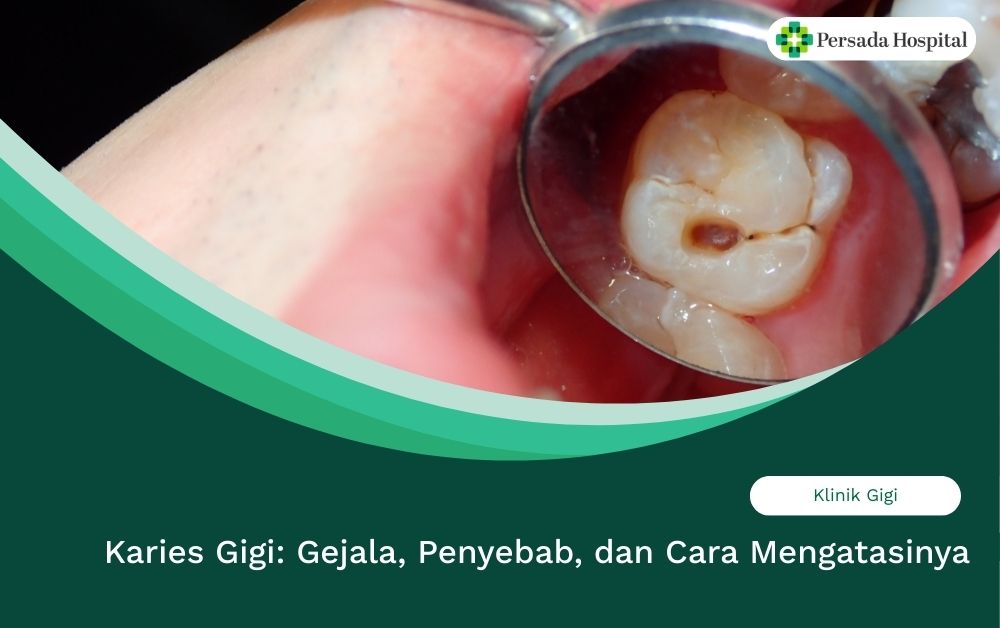 Karies Gigi: Penyebab, Gejala, dan Cara Mengatasinya