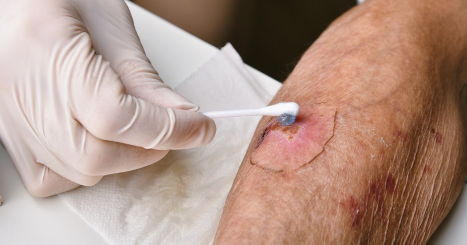 Pahami Perawatan Luka Diabetes yang Tepat