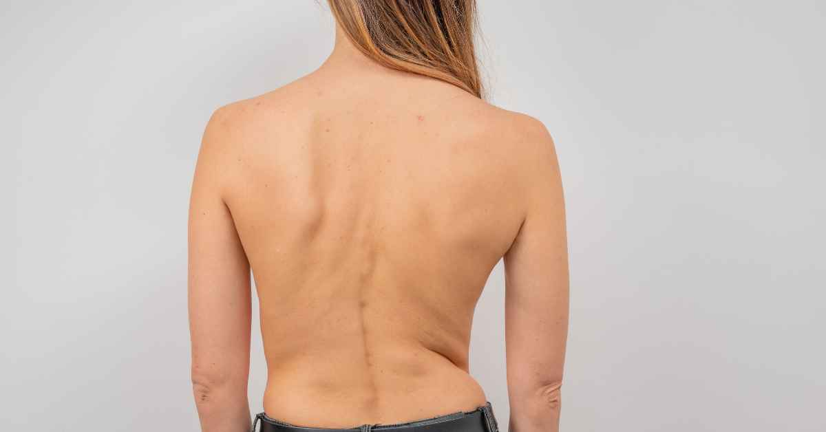 Macam-Macam Olahraga Skoliosis yang Perlu Dirutinkan