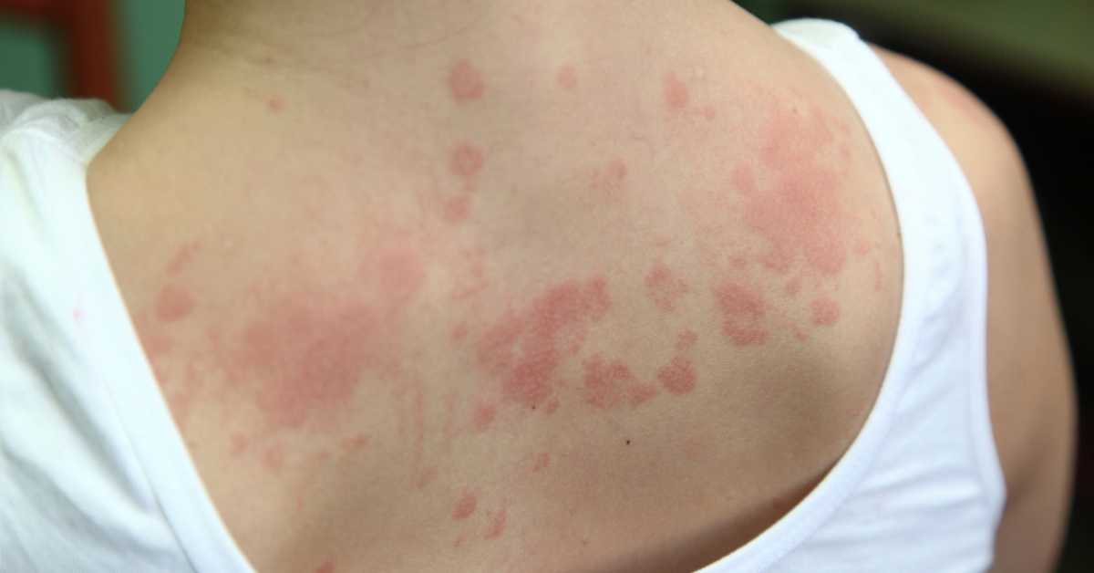 Mengenal Dermatitis: Jenis, Penyebab, dan Penanganan