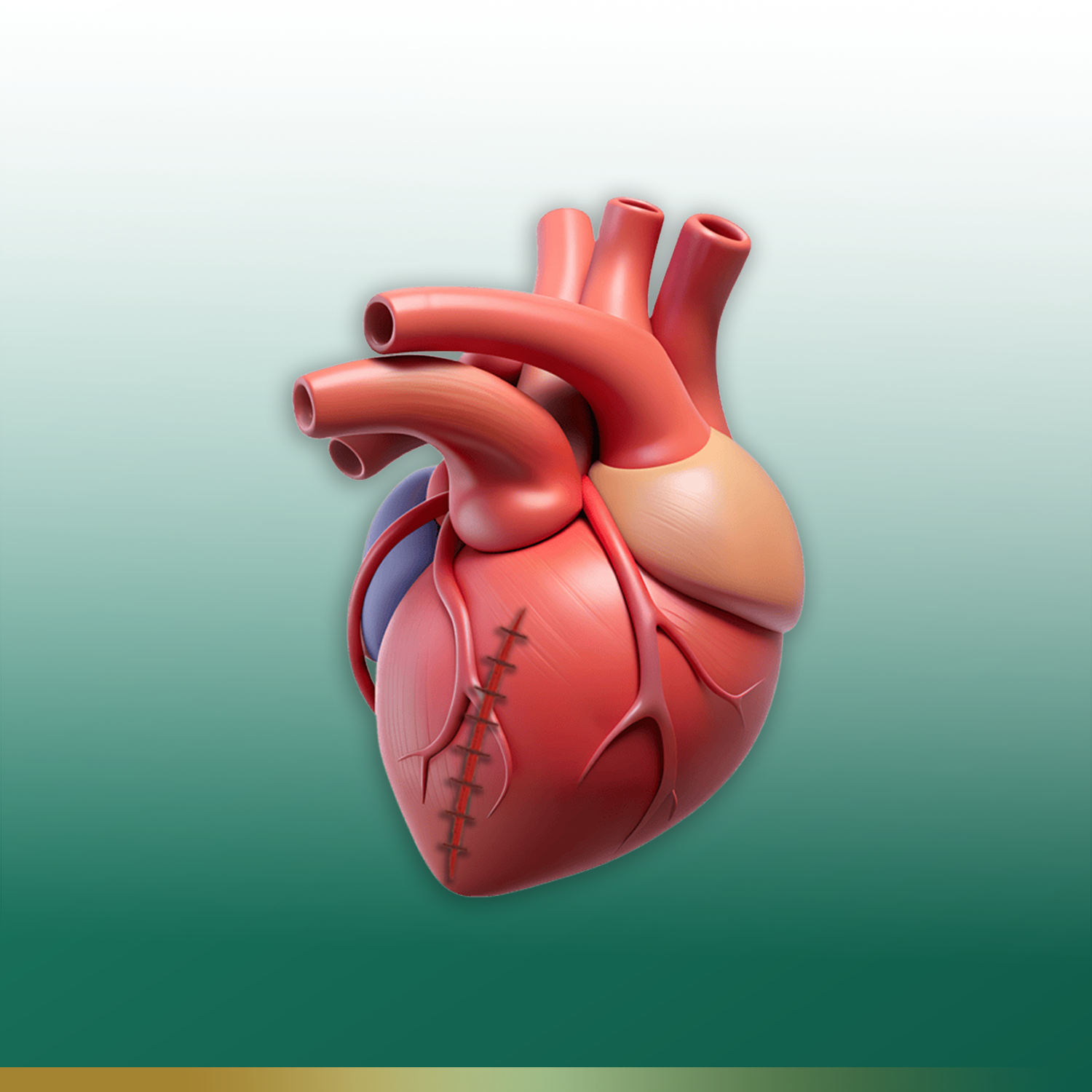 Operasi CABG (Bypass Jantung)